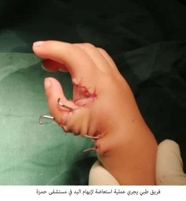 فريق طبي يجري عملية استعاضة لإبهام اليد في مستشفى الأمير حمزة