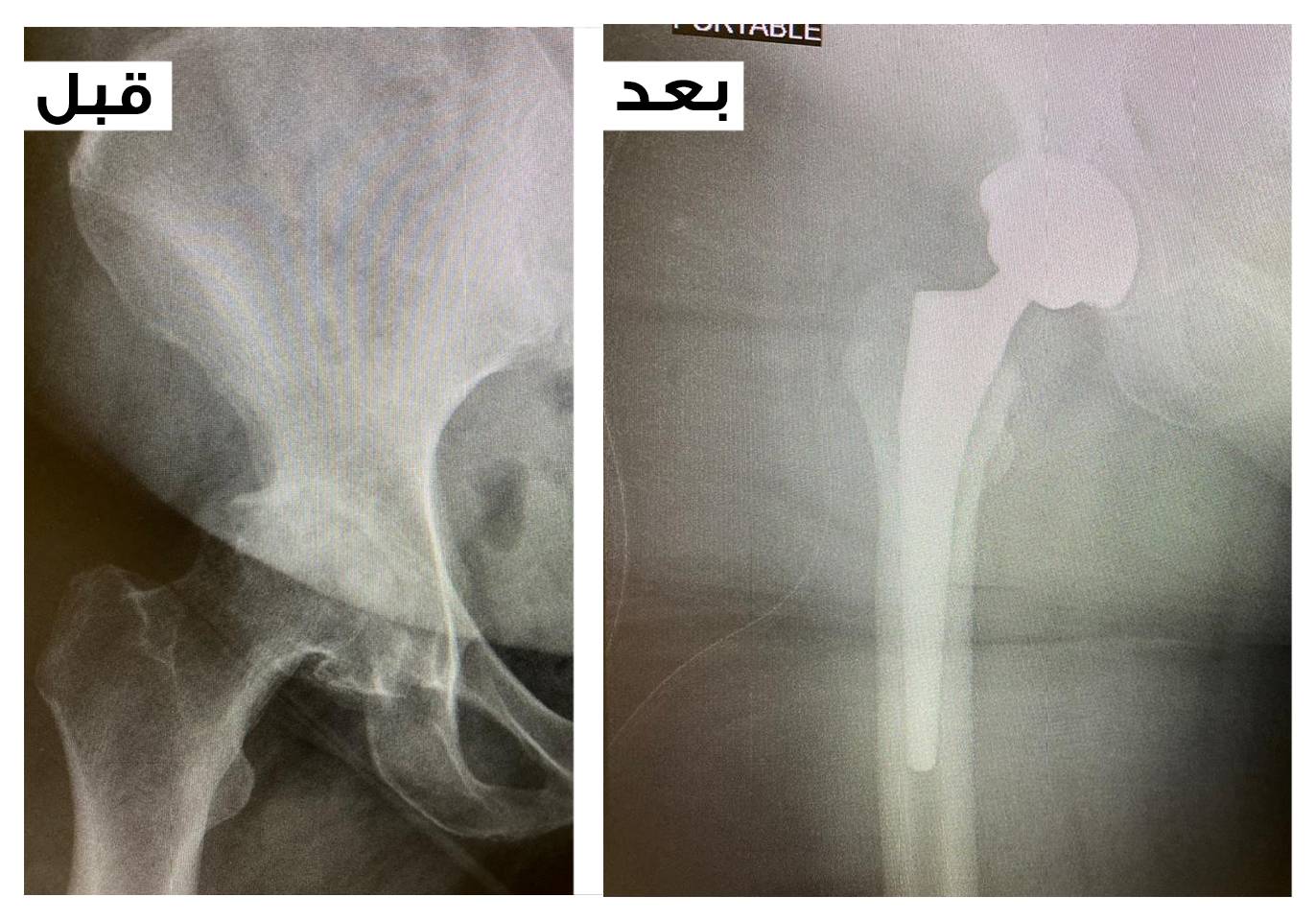 السعودي الألماني دبي یستبدل مفصل الورك لمریضة خمسینیة وزنھا 148 كج