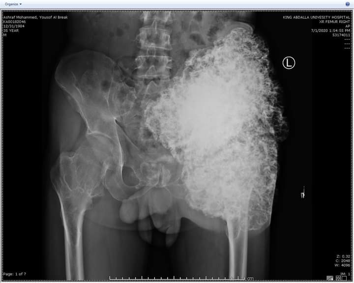 عملية نوعية في مستشفى الملك المؤسس لمريض ثلاثيني يعاني من ورم عظمي ضخم داخل تجويف الحوض