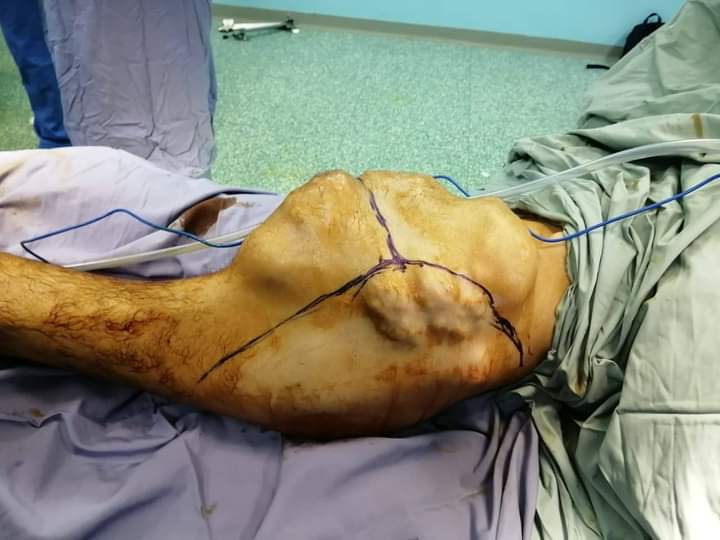 عملية نوعية في مستشفى الملك المؤسس لمريض ثلاثيني يعاني من ورم عظمي ضخم داخل تجويف الحوض