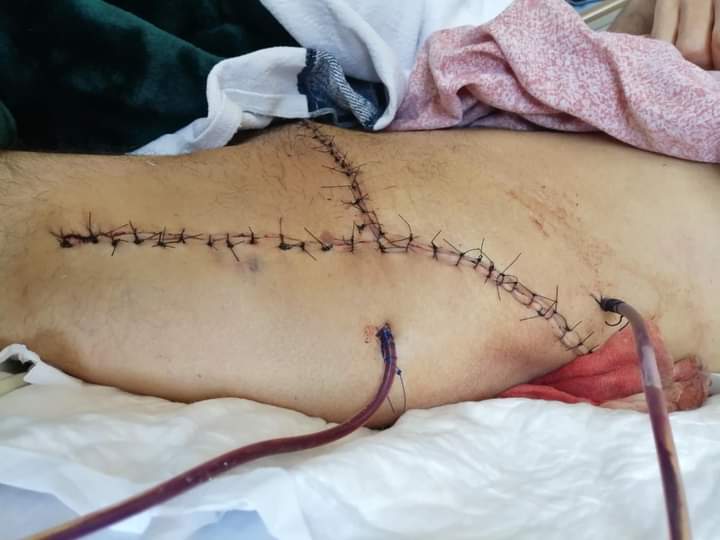 عملية نوعية في مستشفى الملك المؤسس لمريض ثلاثيني يعاني من ورم عظمي ضخم داخل تجويف الحوض