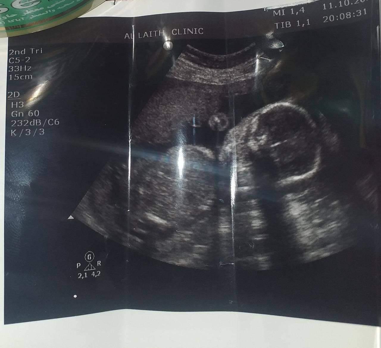 بإستخدام تقنية الناظور البطني.. الدكتورة الأستشارية أزهار العضب تضع حداً لعقم النساء 