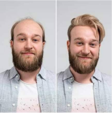 شركة healthy hair club تفتتح فرعها  في الاردن وتقدم افضل انواع البواريك الطبية التجميلية  للجمهور