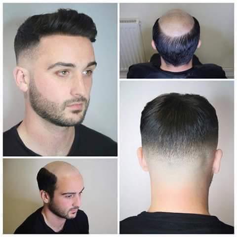 شركة healthy hair club تفتتح فرعها  في الاردن وتقدم افضل انواع البواريك الطبية التجميلية  للجمهور