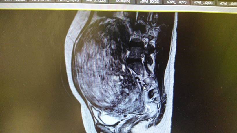 استئصال ورم ليفي بحجم كرة القدة بالجراحة التنظيرية بالسعودي الالماني دبي