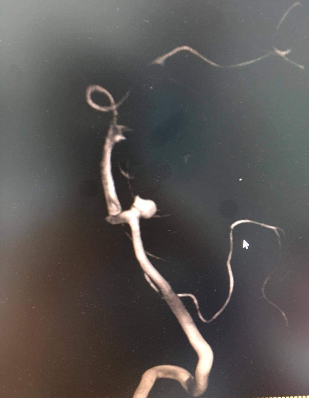 مستشفى الملك المؤسس : إجراء عملية نوعية لمريضة تعاني من نزيف دماغي حاد ناتج عن وجود تشوه شرياني في الشريان الأساسي من جذع الدماغ  