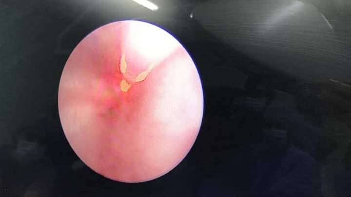 فتح مجرى البول لجنين داخل رحم والدته بواسطة التنظير والليزر في مستشفى الجامعة الأردنية 