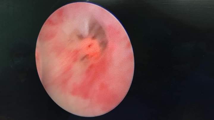 فتح مجرى البول لجنين داخل رحم والدته بواسطة التنظير والليزر في مستشفى الجامعة الأردنية 