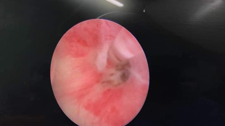 فتح مجرى البول لجنين داخل رحم والدته بواسطة التنظير والليزر في مستشفى الجامعة الأردنية 