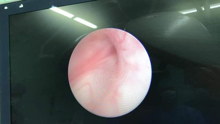 فتح مجرى البول لجنين داخل رحم والدته بواسطة التنظير والليزر في مستشفى الجامعة الأردنية 