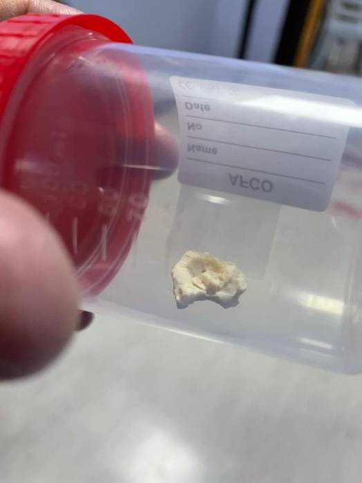 إزالة قطعة جميد أغلقت مريء طفلة في الخامسة من عمرها في مستشفى الجامعة الأردنية