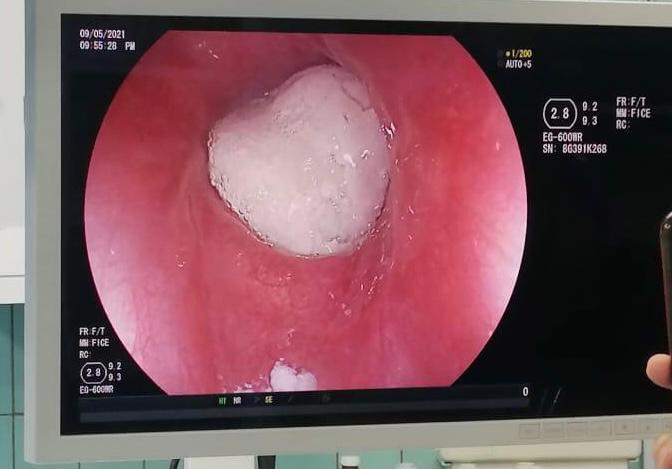 إزالة قطعة جميد أغلقت مريء طفلة في الخامسة من عمرها في مستشفى الجامعة الأردنية 