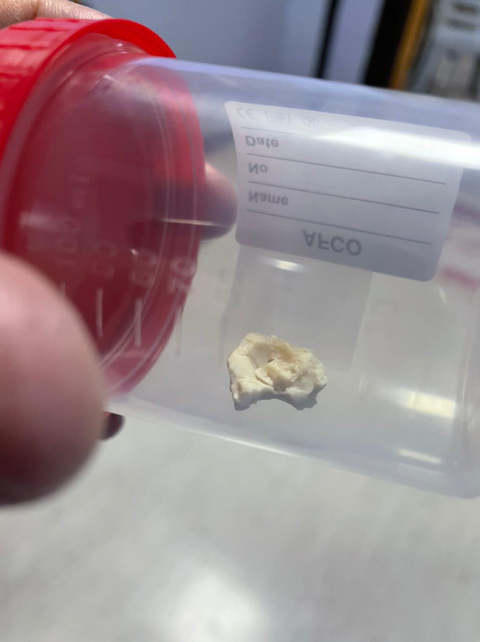 إزالة قطعة جميد أغلقت مريء طفلة في الخامسة من عمرها في مستشفى الجامعة الأردنية 