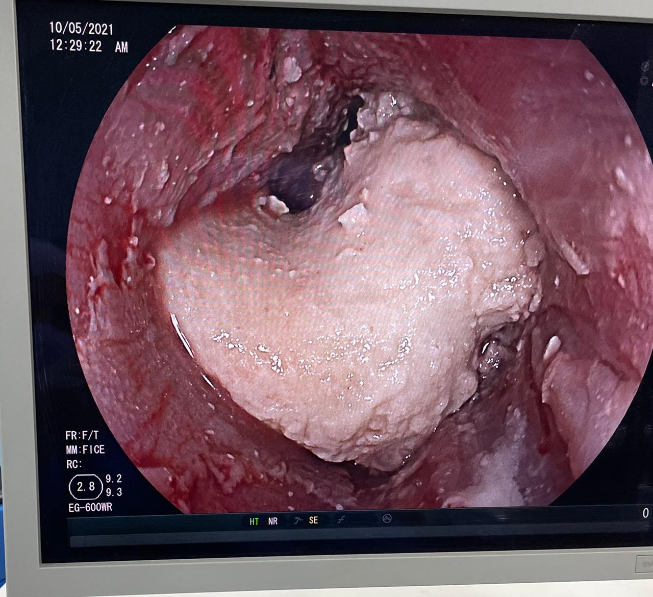 إزالة قطعة جميد أغلقت مريء طفلة في الخامسة من عمرها في مستشفى الجامعة الأردنية 