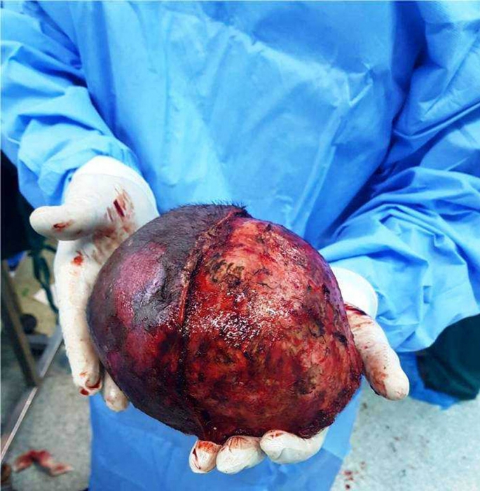 استئصال ورم سحائي كبير من دماغ وجمجمة مريض في مستشفى الاميرة بسمة