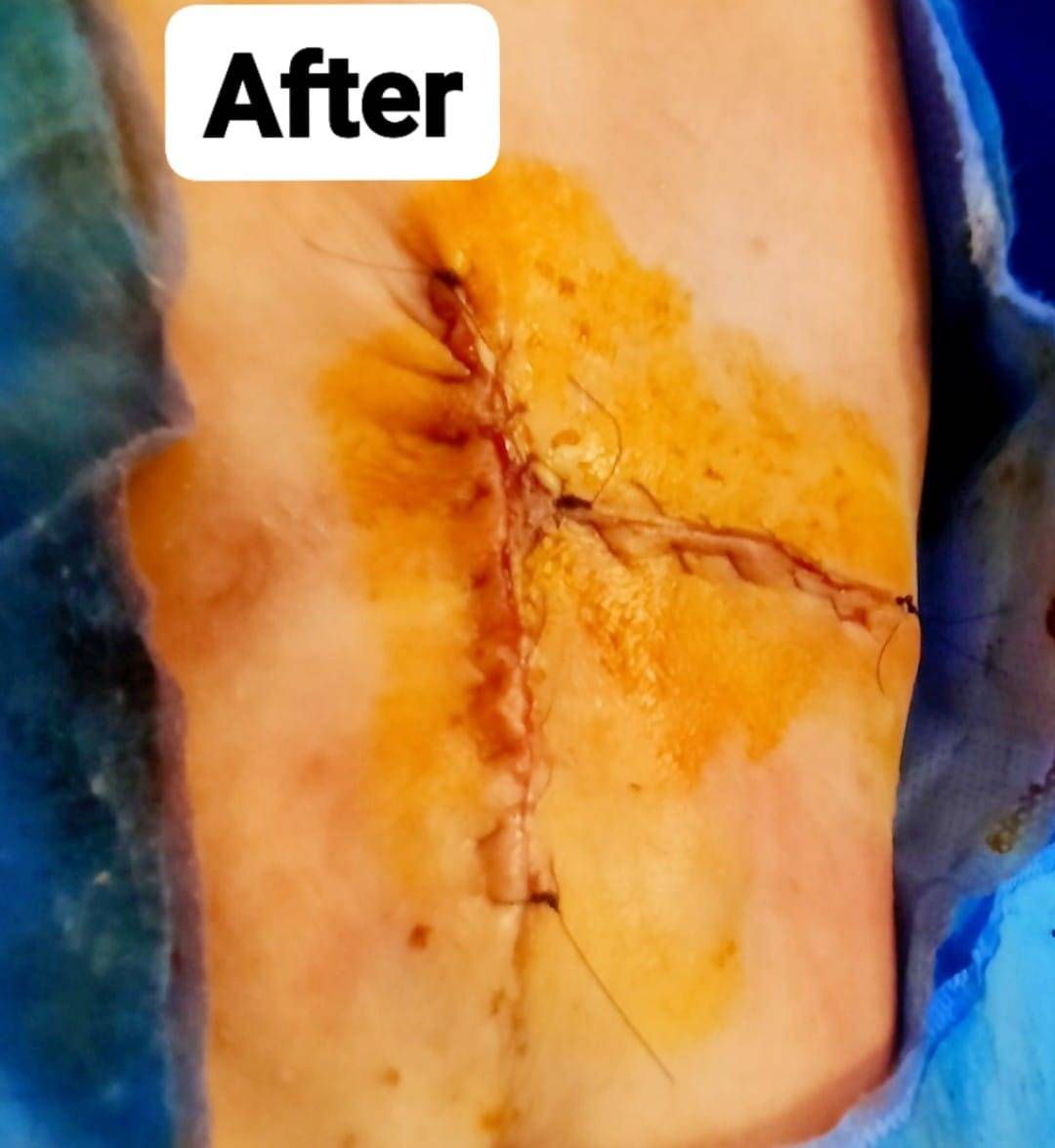 مستشفى الزرقاء الحكومي ولأول مرة يجري عملية جراحية معقدة ونادره لطفل عمره اسبوعين بنجاح ... صور  .