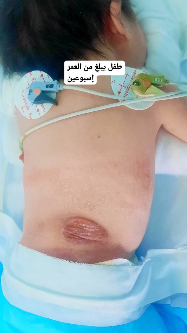 مستشفى الزرقاء الحكومي ولأول مرة يجري عملية جراحية معقدة ونادره لطفل عمره اسبوعين بنجاح ... صور  .