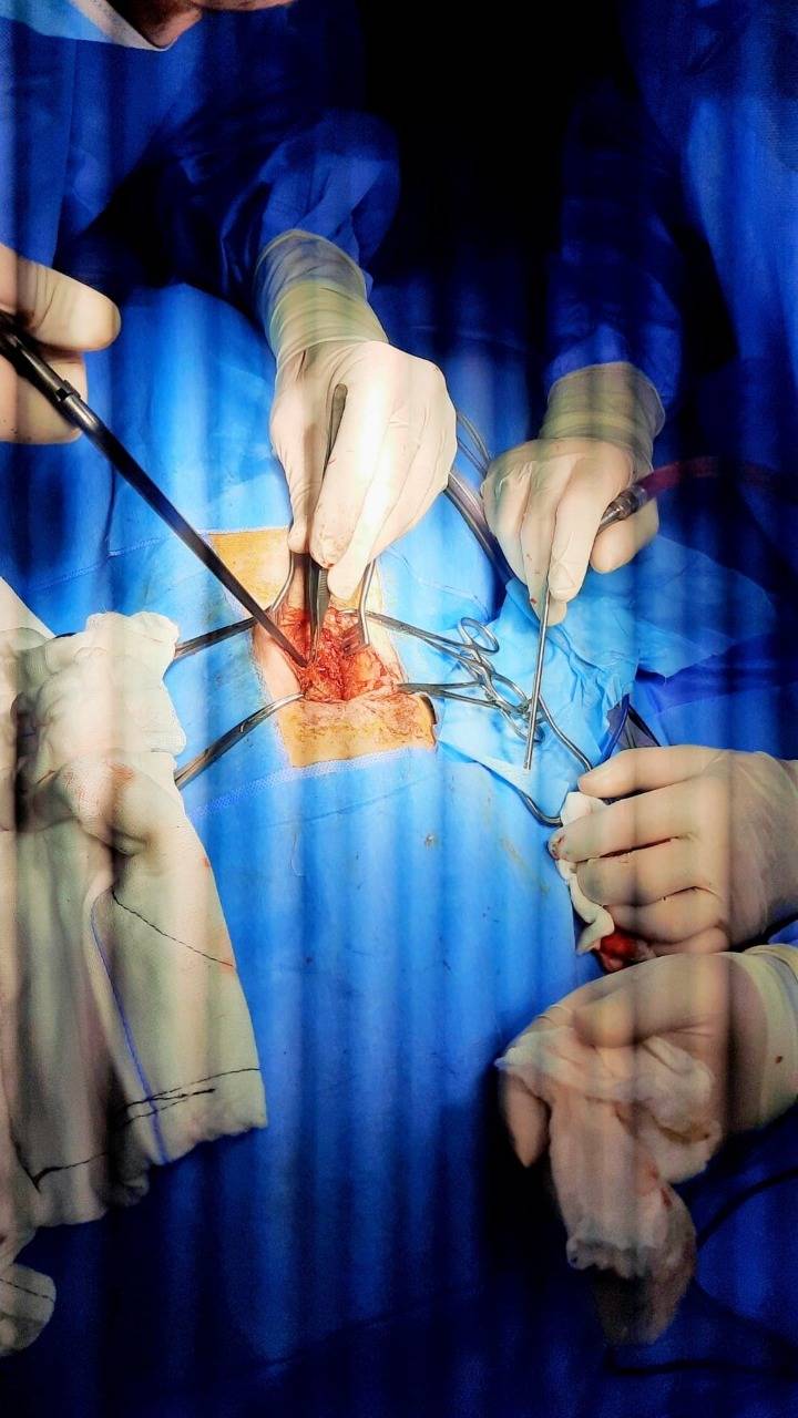 مستشفى الزرقاء الحكومي ولأول مرة يجري عملية جراحية معقدة ونادره لطفل عمره اسبوعين بنجاح ... صور  .