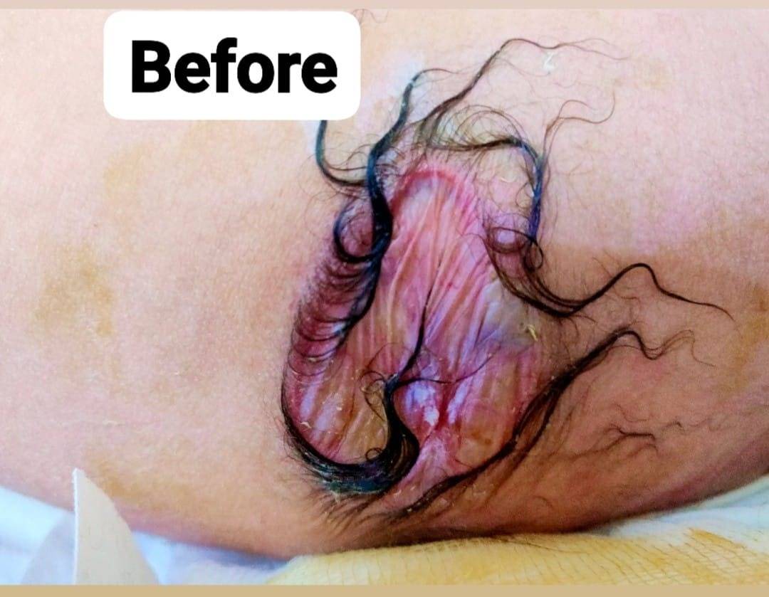 مستشفى الزرقاء الحكومي ولأول مرة يجري عملية جراحية معقدة ونادره لطفل عمره اسبوعين بنجاح ... صور  .