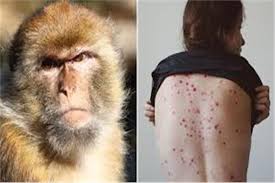المغرب يعلن تسجيل أول حالة إصابة بجدري القرود