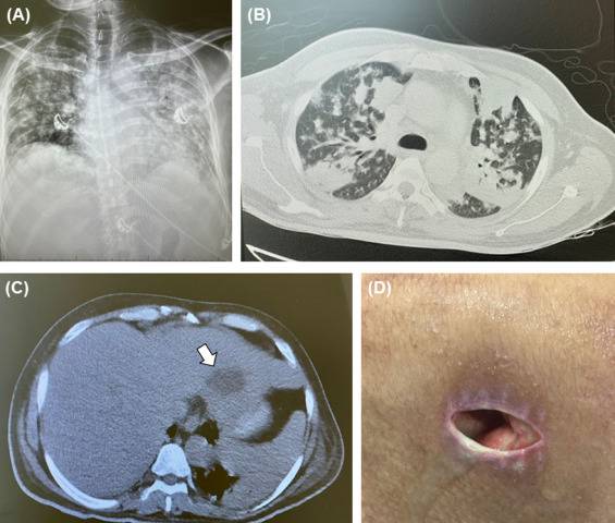 مستشفى بالإمارات يتوصل لخطة علاج جديدة عالميا لعدوى بكتيريه خطرة