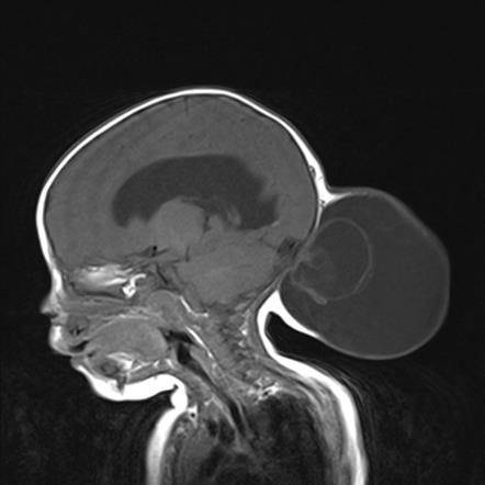 جراحة دقيقة لاصلاح عيب خلقي في رأس رضيعة سعودية