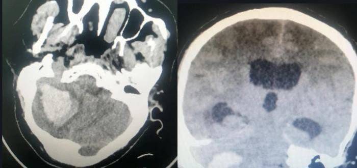 ترميم جمجمة سعودي أصابها التآكل