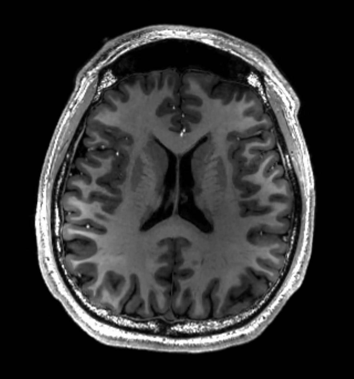 باحثون تمكنوا من إنتاج صورة لتجمعات الصوديوم في الدماغ