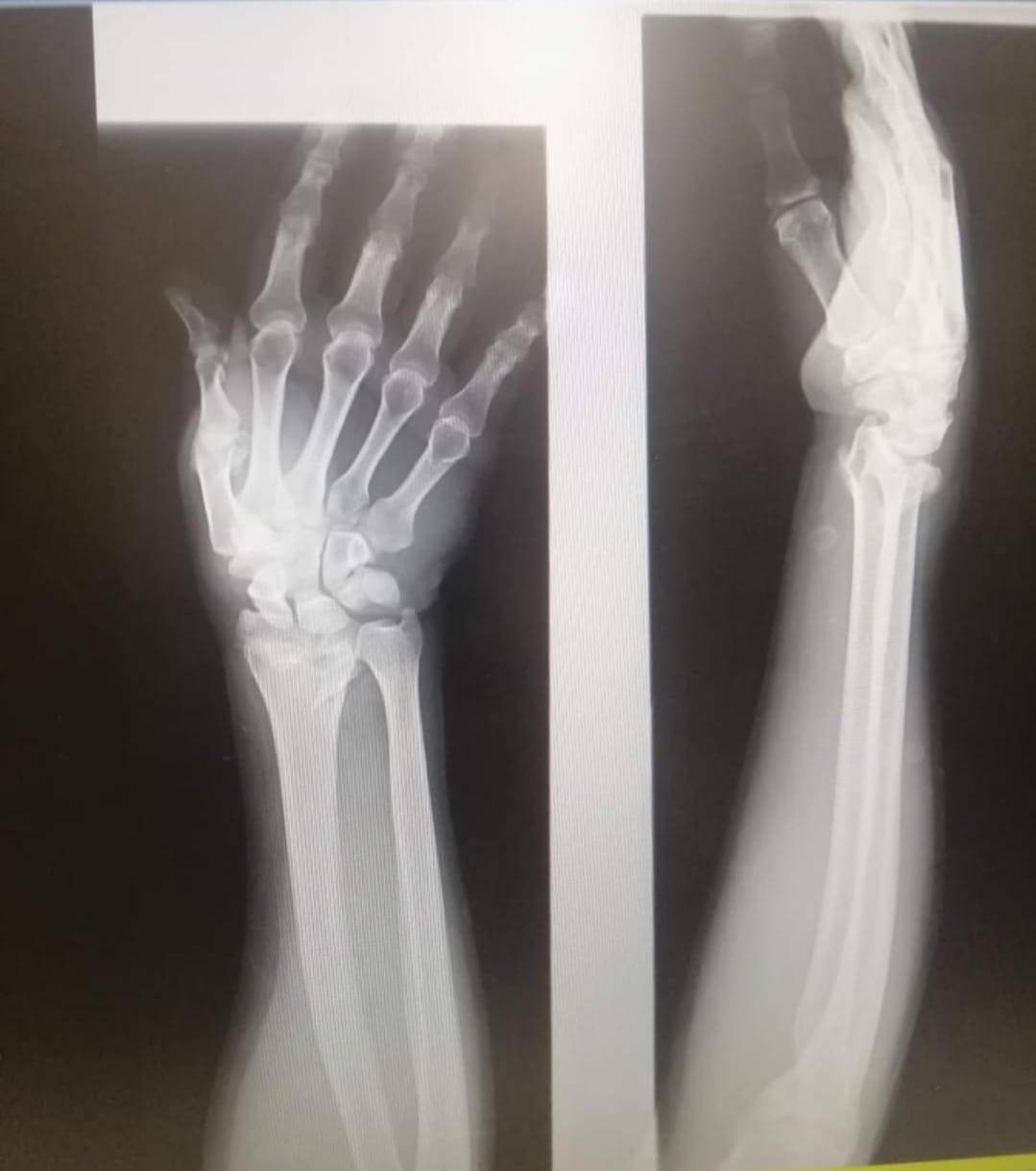 البريزات طبيب العظام البارع  والمتميز