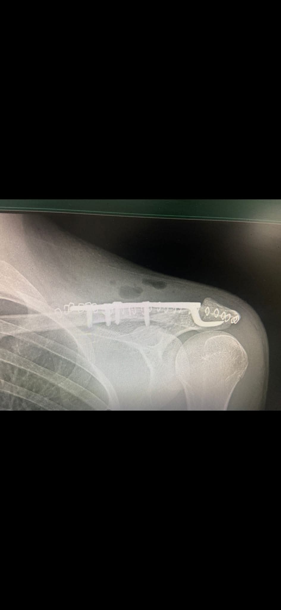 البريزات طبيب العظام البارع  والمتميز