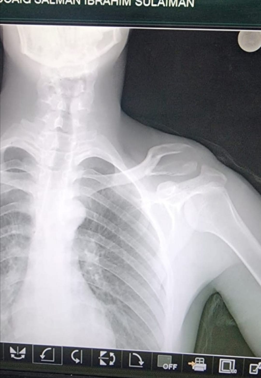 البريزات طبيب العظام البارع  والمتميز