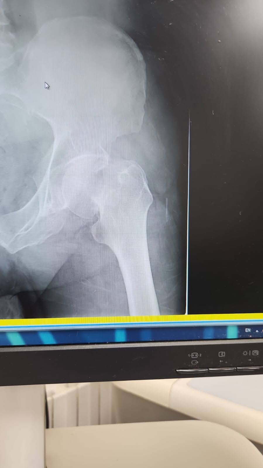 البريزات طبيب العظام البارع  والمتميز