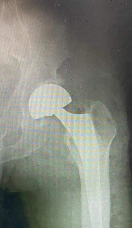 البريزات طبيب العظام البارع  والمتميز