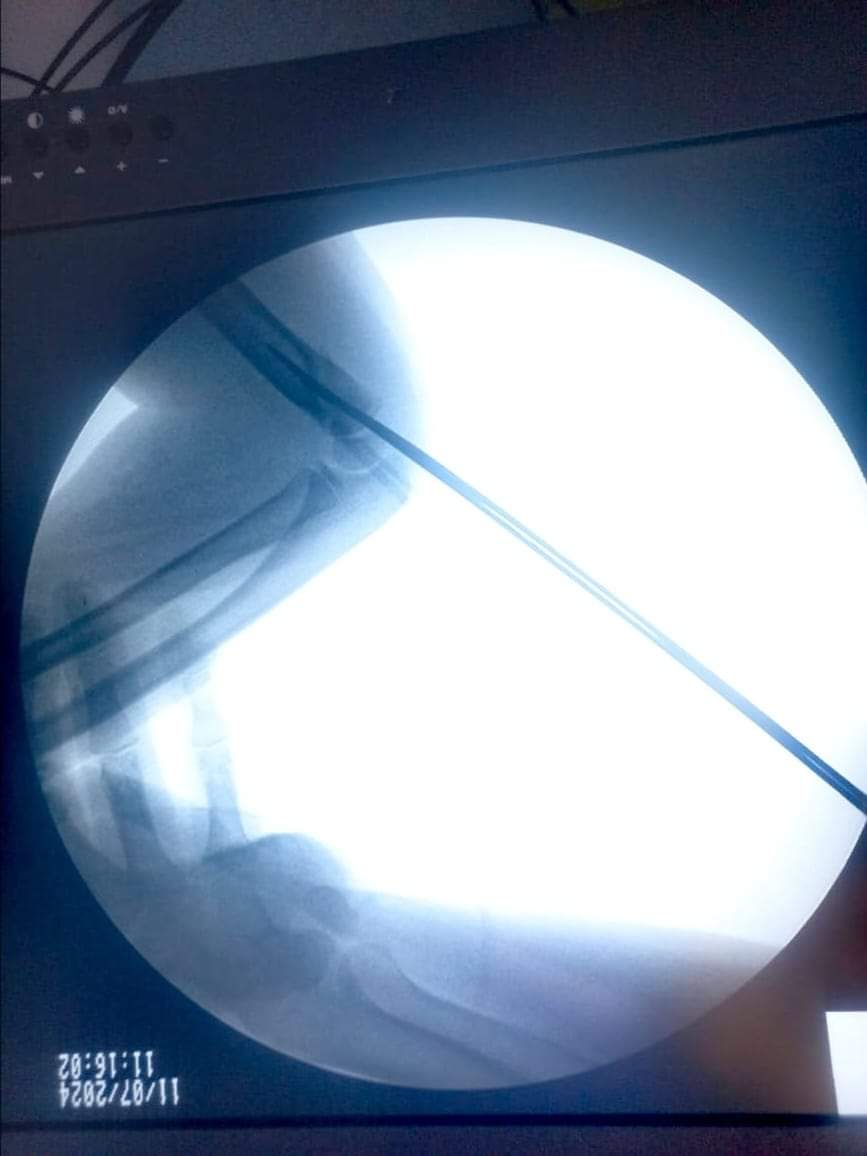 البريزات طبيب العظام البارع  والمتميز