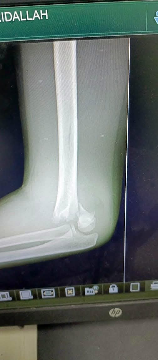 البريزات طبيب العظام البارع  والمتميز