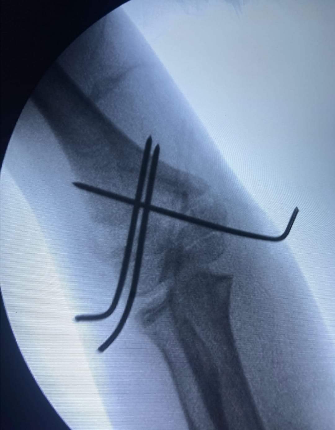 البريزات طبيب العظام البارع  والمتميز