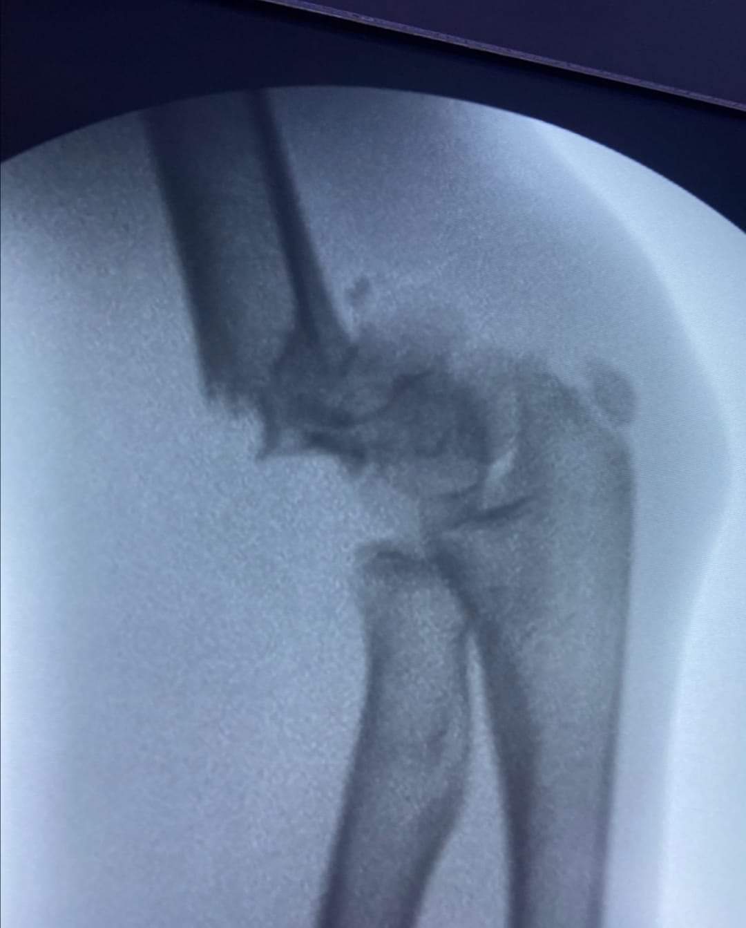 البريزات طبيب العظام البارع  والمتميز