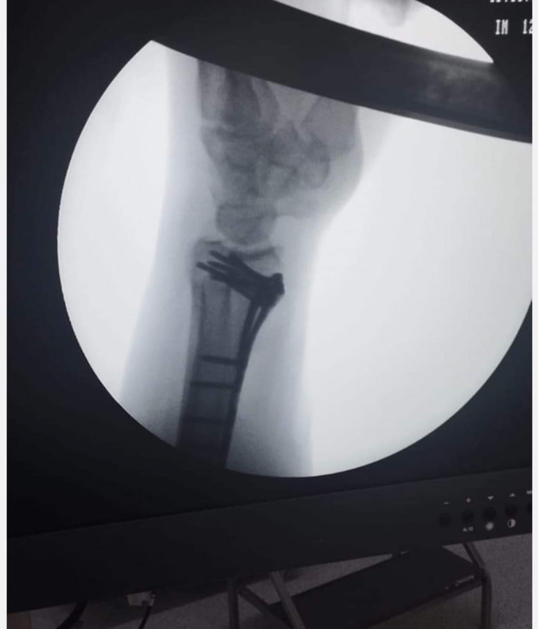 البريزات طبيب العظام البارع  والمتميز