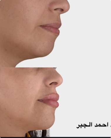 أنواع الفيلر وحقن البوتوكس: متى تختار كل إجراء؟